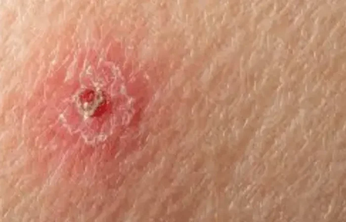 Angiosarkoma