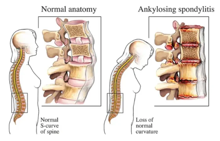 Mengenal Ankylosing Spondylitis dan Cara Menanganinya