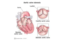 Aortic Stenosis