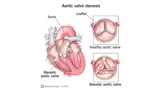 Aortic Stenosis 4 Mengenal Aortic Stenosis atau Penyempitan Katup Aorta
