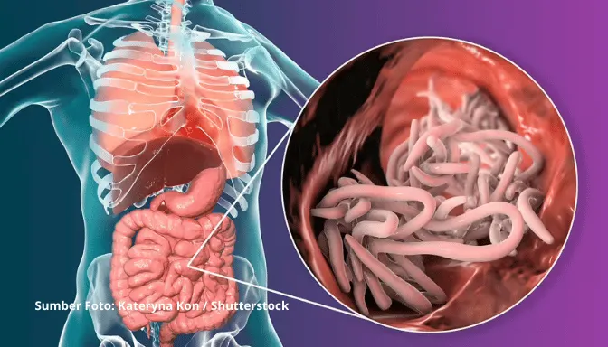 Mengenal Ascariasis, Infeksi Cacing Ascaris lumbricoides