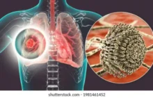 Aspergilosis