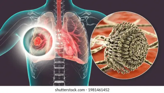Mengenal Aspergilosis, Infeksi Jamur yang Bisa Menyerang Paru