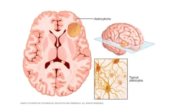 Mengenal Astrositoma, Tumor yang Berasal dari Sel Astrosit