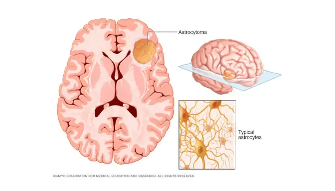 Astrositoma 4 Mengenal Astrositoma, Tumor yang Berasal dari Sel Astrosit