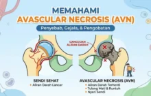 Avascular Necrosis