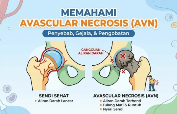 Mengenal Avascular Necrosis atau Kematian Jaringan Tulang