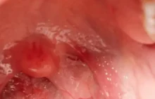 Adenoiditis
