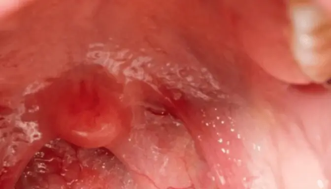 Pembesaran dan Radang Adenoid (Adenoiditis)