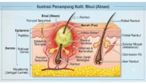 Kenapa Bisul Tidak Boleh Dipencet? Ini Alasannya
