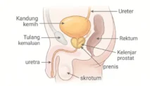 BPH (Benign Prostate Hyperplasia)