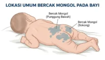 Bercak Mongol pada Bayi: Bahaya atau Normal?
