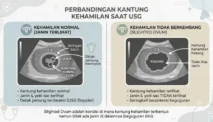 Apa itu Blighted Ovum? Penyebab dan Penanganannya