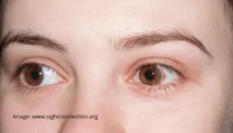 Xerophthalmia